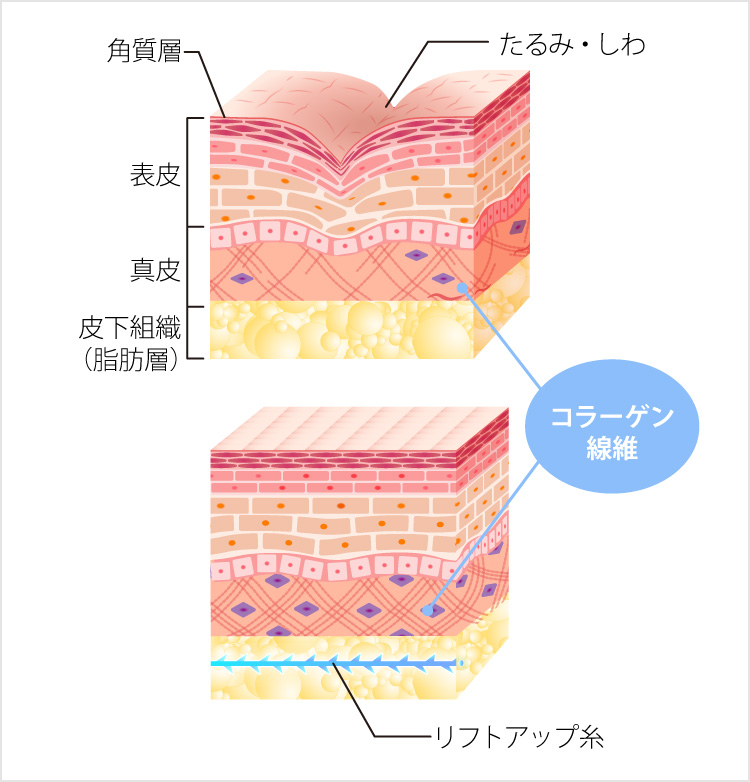 糸リフトをいれた皮膚組織の断面図