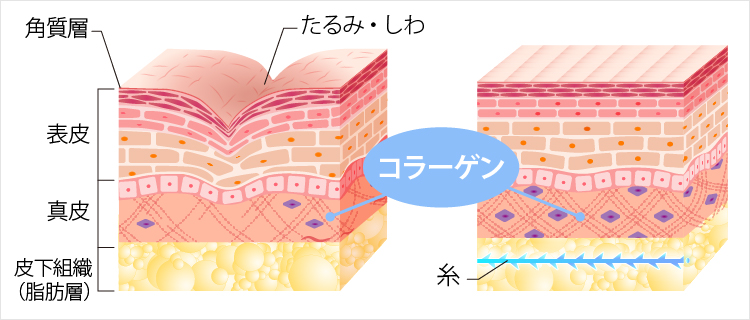 糸リフトで肌のハリ・ツヤが回復するイラスト