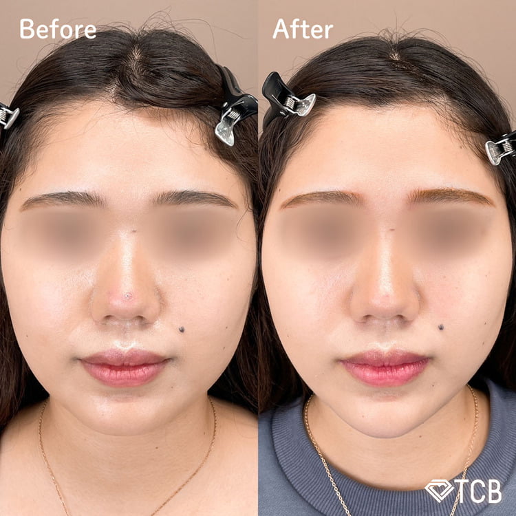 TCB小顔リフトの症例写真01