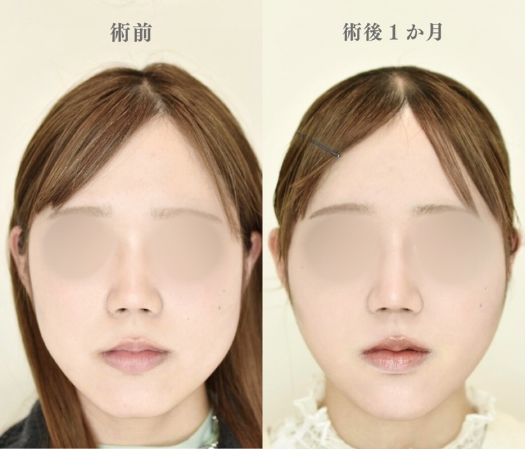 TCB小顔リフトの症例写真02
