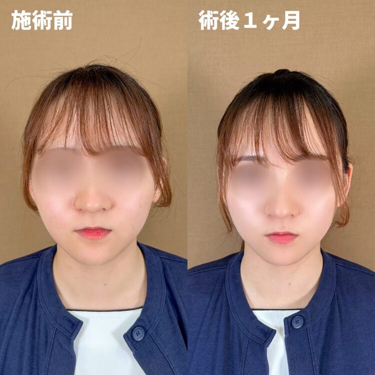 クリアファインリフトの症例写真01