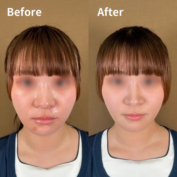 クリアファインリフトの症例写真02