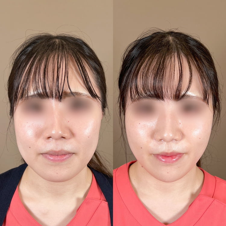 小顔美肌再生（リフトアップ）の症例写真01