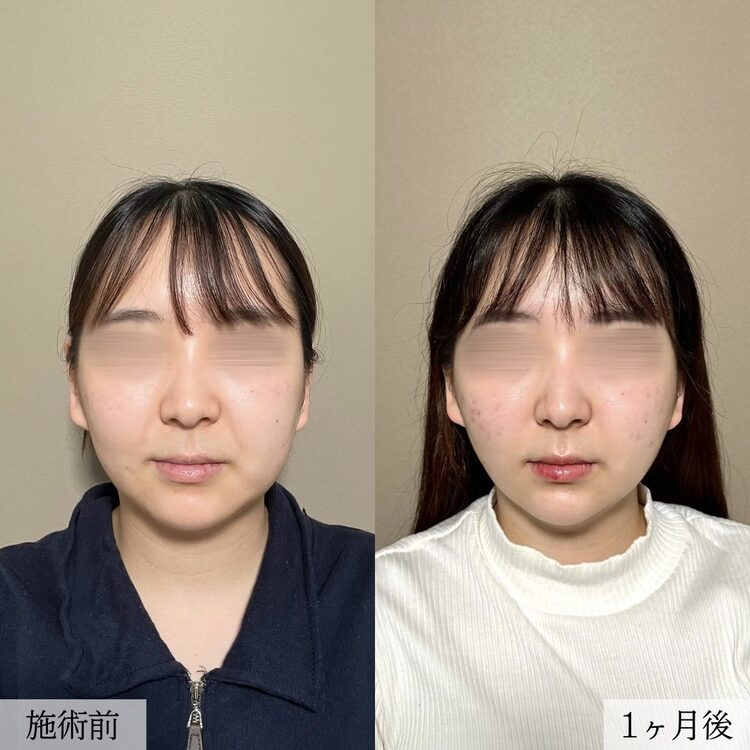 小顔美肌再生（リフトアップ）の症例写真02