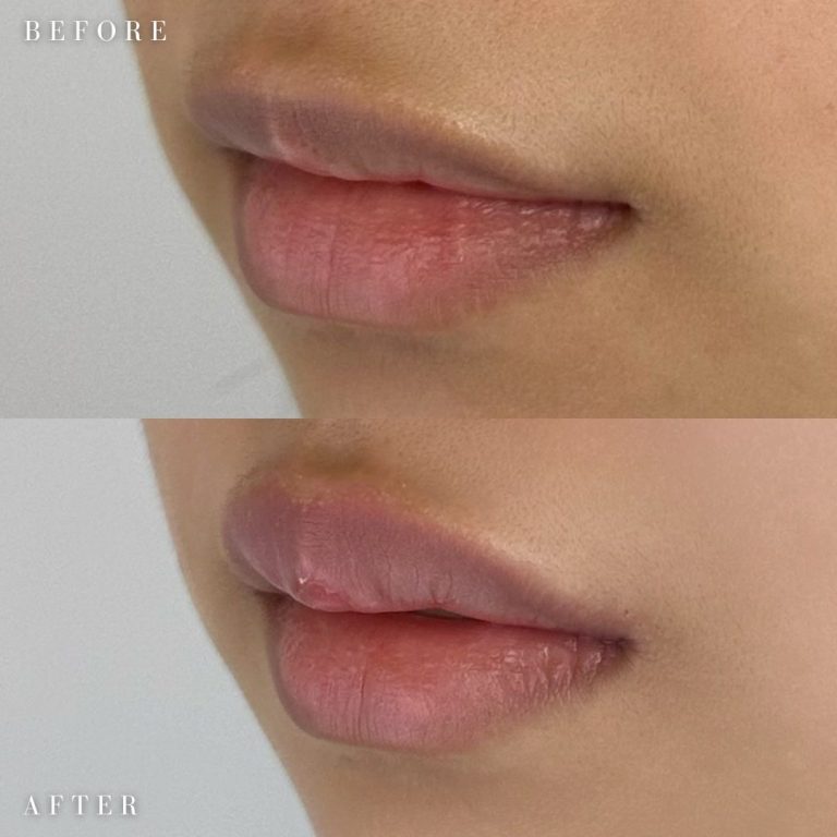 唇のヒアルロン酸注射の症例写真