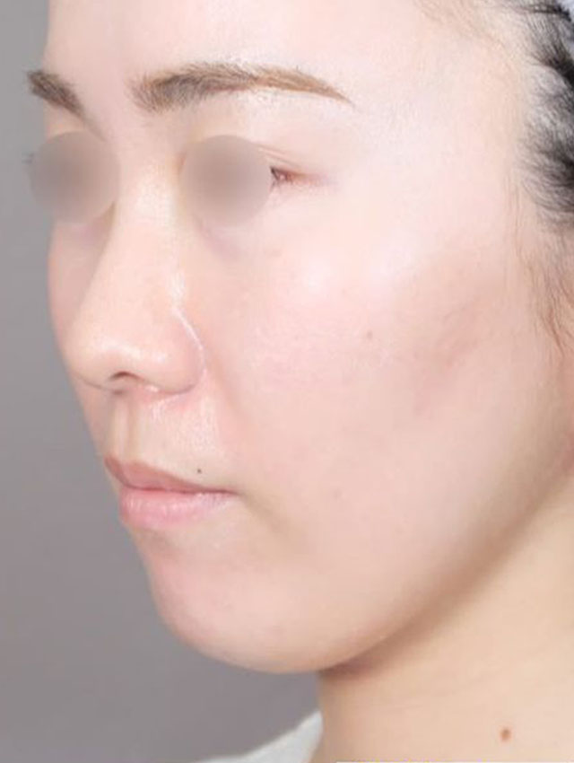 顔（頬・頬骨上・顎下）の脂肪吸引症例写真01 AFTER