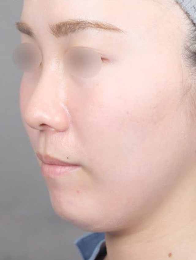 顔（頬・頬骨上・顎下）の脂肪吸引症例写真01 BEFORE