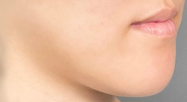 顔（頬・頬骨上・顎下）の脂肪吸引症例写真02 BEFORE