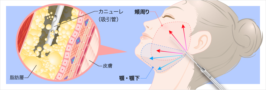 カニューレ（吸引管）を挿入して頬・顎・顎下の脂肪を吸引します