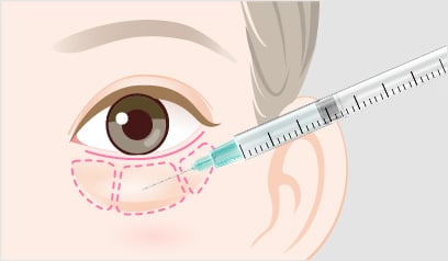 裏ハムラ法の手術方法2