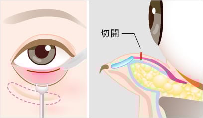裏ハムラ法の手術方法3