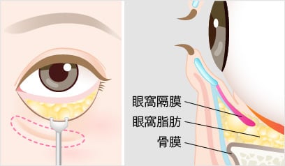 裏ハムラ法の手術方法4
