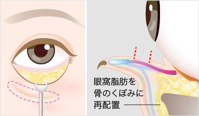 裏ハムラ法の手術方法5
