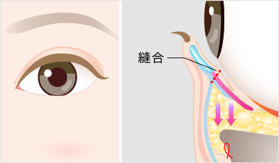 裏ハムラ法の手術方法6