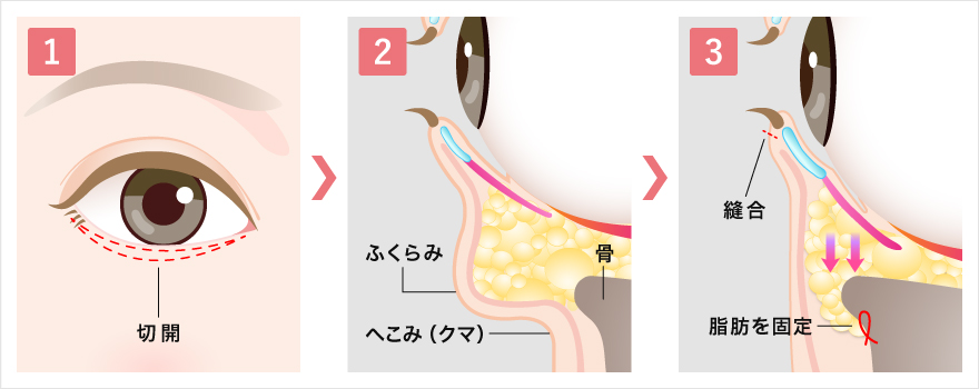 ハムラ法の手術方法