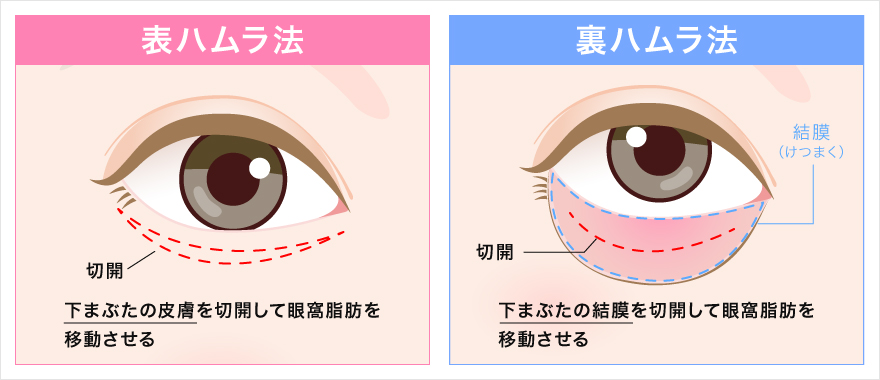 表ハムラ法と裏ハムラ法の違い