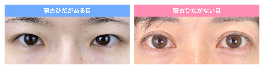 蒙古ひだがある目とない目を比較した画像