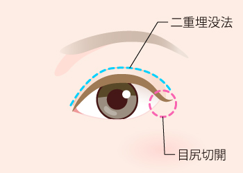 目尻切開＋二重埋没法のイラスト