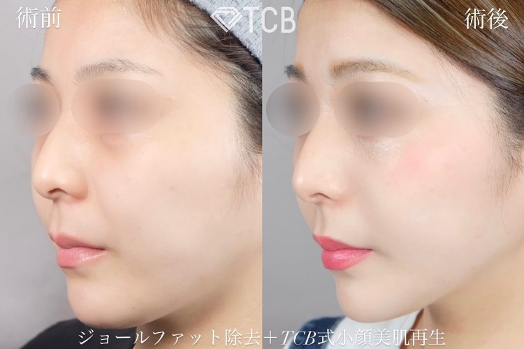 TCB小顔リフトの症例写真