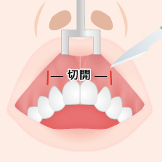 口腔内の切開図