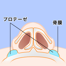 プロテーゼの挿入図