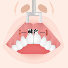 口腔内の縫合図