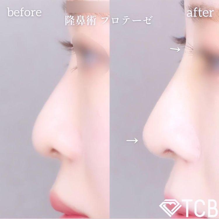 鼻プロテーゼ（隆鼻術） | 鼻の整形 | 美容整形はTCB東京中央美容外科