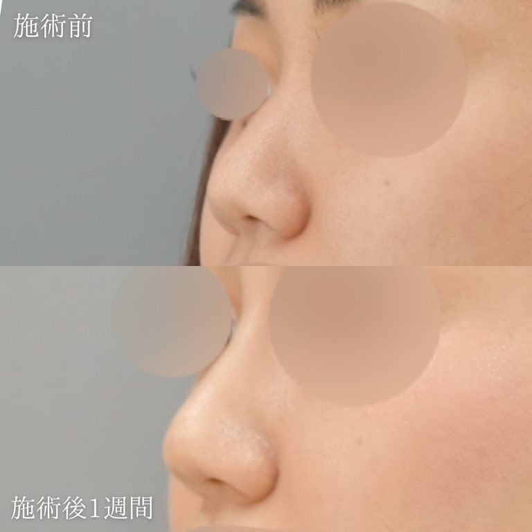 鼻プロテーゼの症例写真