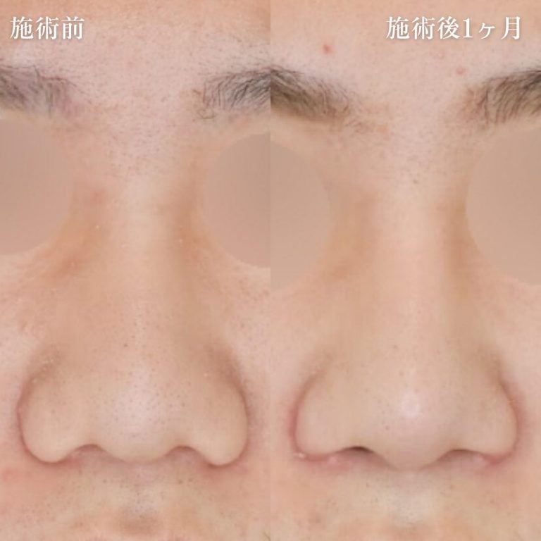 鼻プロテーゼの症例写真