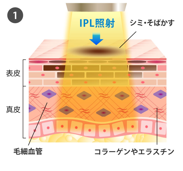 IPL光治療の効果1