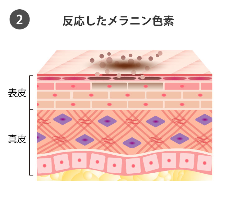 IPL光治療の効果2