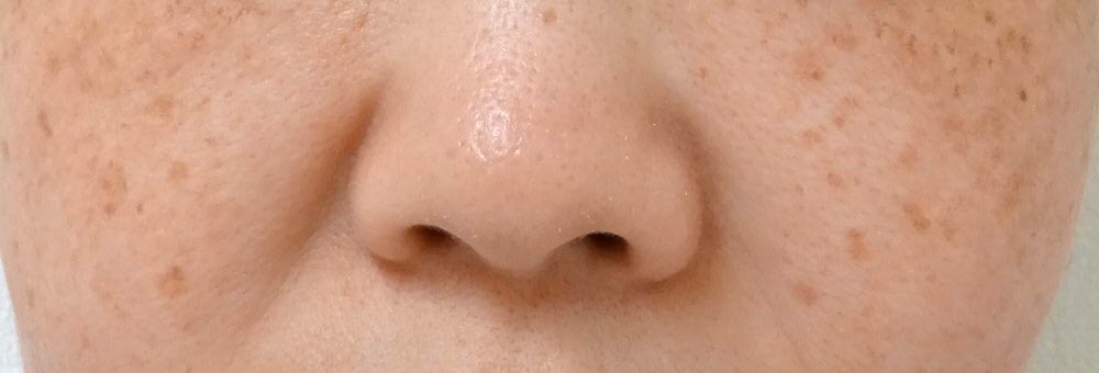 シミ取り放題レーザー治療の症例写真01