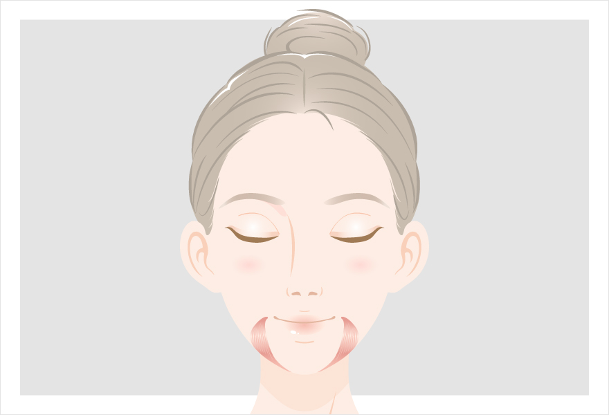 口角ボトックスを打つ部位を説明する画像