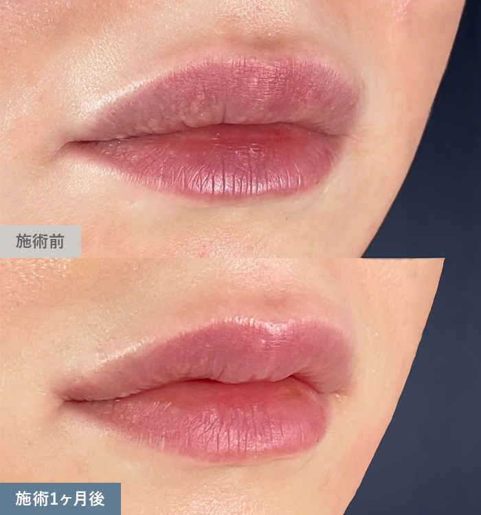 口角挙上術の症例写真01