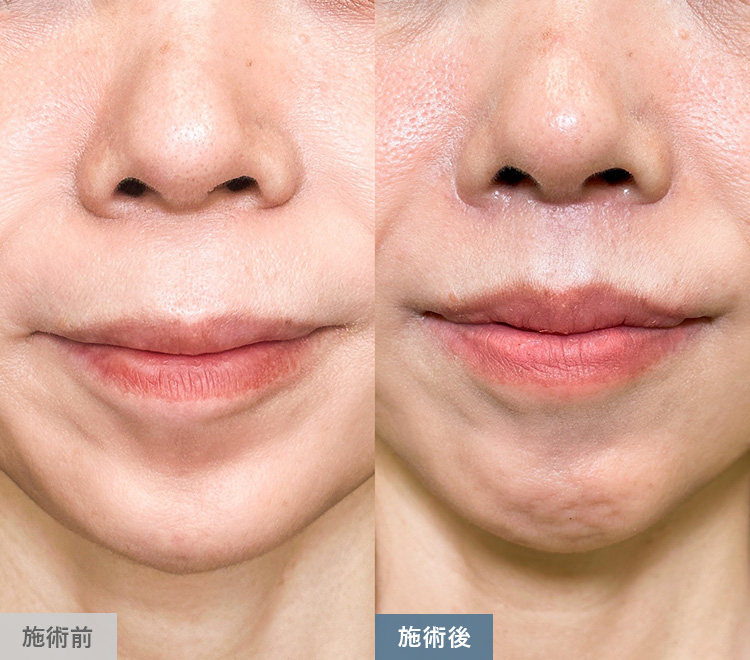 口角挙上術の症例写真03