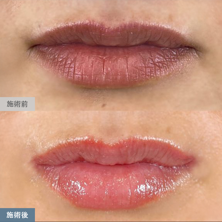 口角挙上術の症例写真04