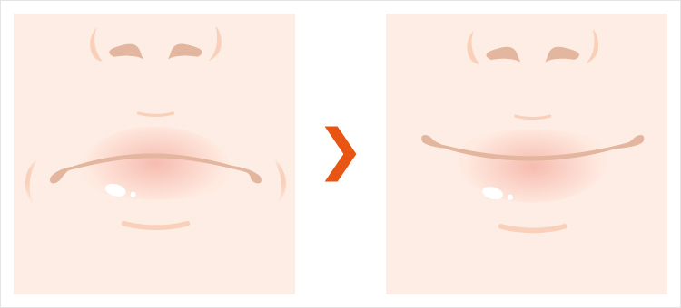 口角挙上術を施した唇の施術前後の変化