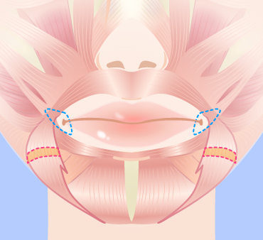 口角挙上の手術方法02