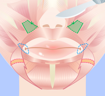 口角挙上の手術方法03