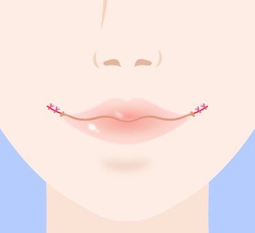 口角挙上の手術方法04