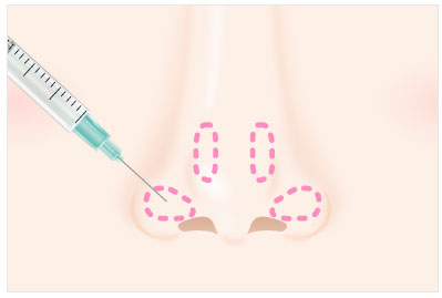 小鼻縮小脂肪溶解注射（BNLS アルティメット）の施術イメージ