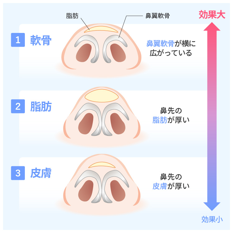 だんご鼻の原因のイラスト