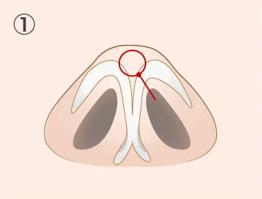 3D鼻尖形成（埋没法）の施術方法01