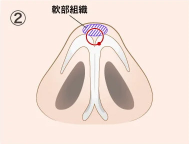 3D鼻尖形成（埋没法）の施術方法02