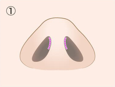 TCB鼻尖形成の手術方法01