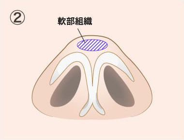 TCB鼻尖形成の手術方法02