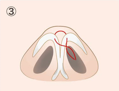TCB鼻尖形成の手術方法03