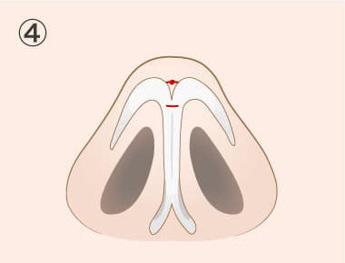 TCB鼻尖形成の手術方法04
