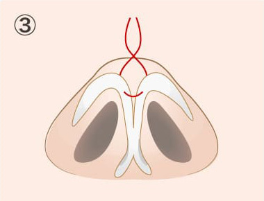 鼻尖形成オープン法（切開法）の手術方法03