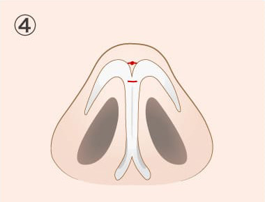 鼻尖形成オープン法（切開法）の手術方法04